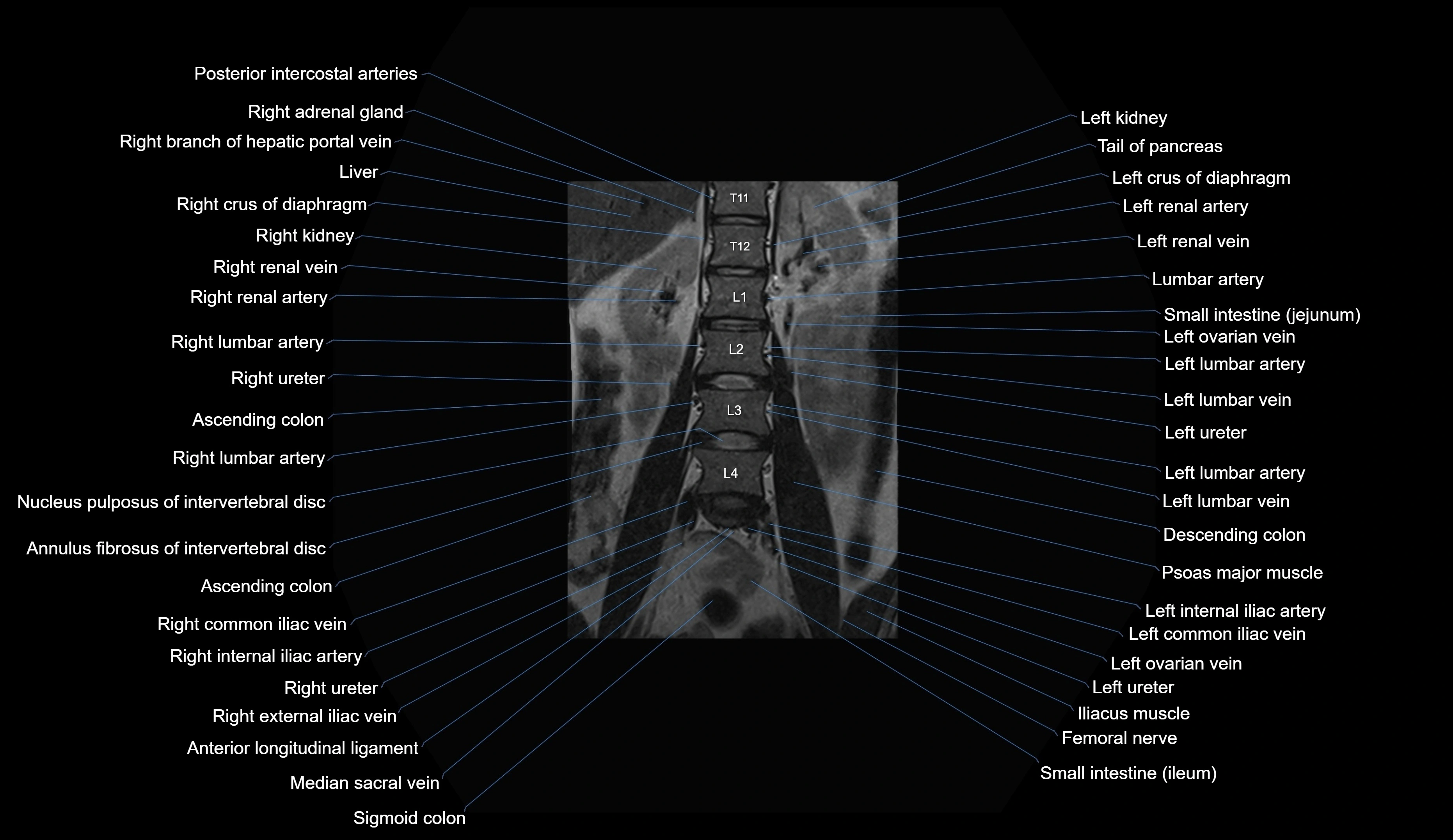 MRI lumbar spine coronal cross sectional anatomy 3T radiology  image-img-00001-00009.webp